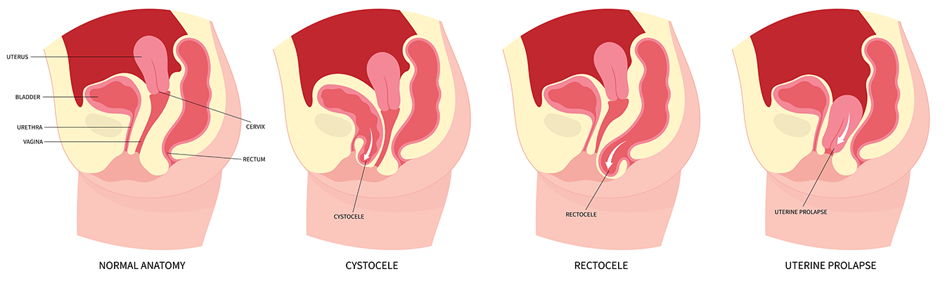 pelvic-organ-prolapse