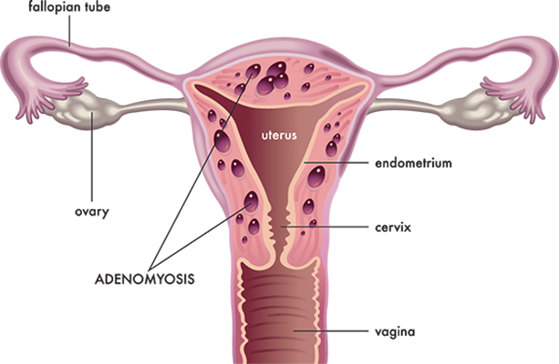 pelvic-pain-adenomyosis-1