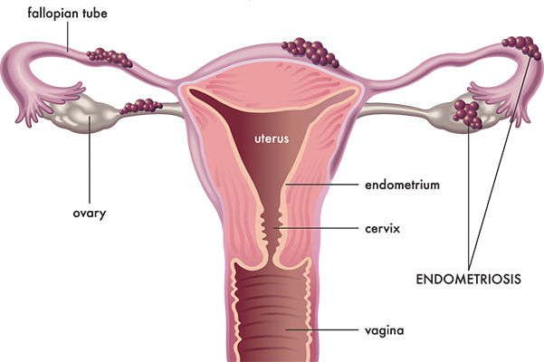 pelvic-pain-endometriosis-1